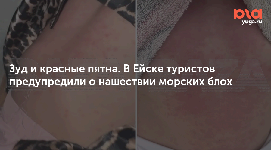 Зуд и красные пятна. В Ейске туристов предупредили о нашествии морских блох