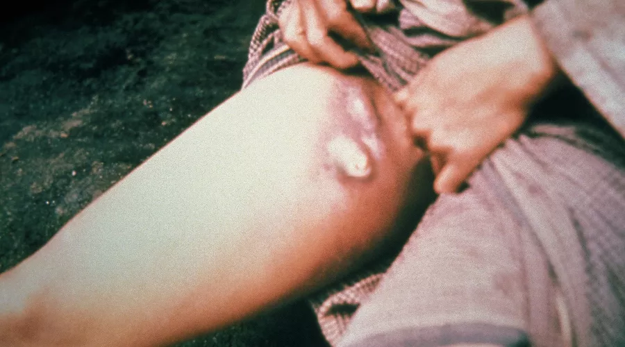 Бубонная чума &copy;&nbsp;Фото The Centers for Disease Control and Prevention's Public Health Image Library (PHIL), identification number #2047, commons.wikimedia.org/w/index.php?curid=6286382